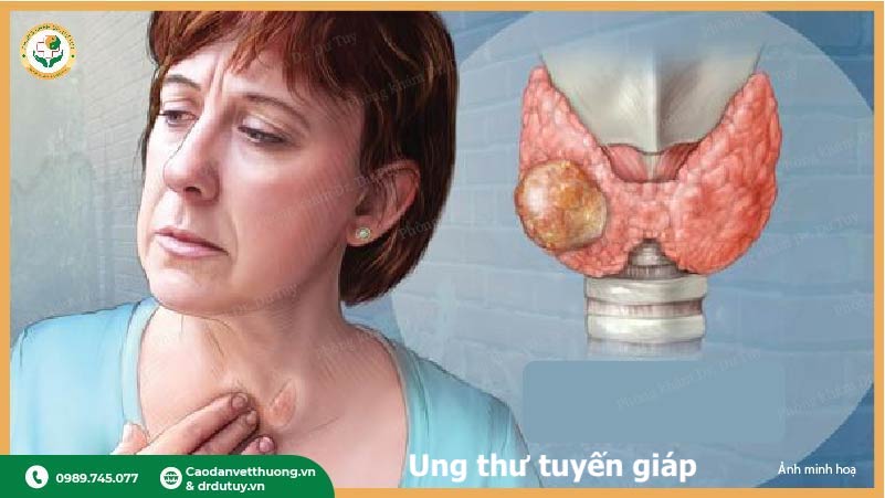 dấu hiệu ung thư tuyến giáp khối u ở cổ