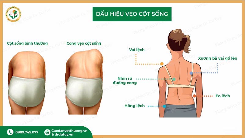 dấu hiệu vẹo cột sống ở trẻ vai lệch hông lệch