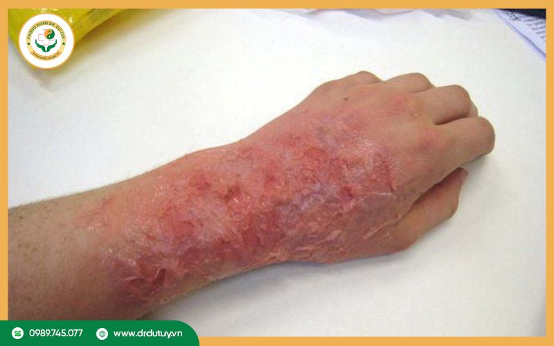 Một số dấu hiệu vết bỏng nhiễm trùng thường gặp