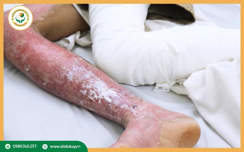Nguyên nhân vết bỏng bị nhiễm trùng