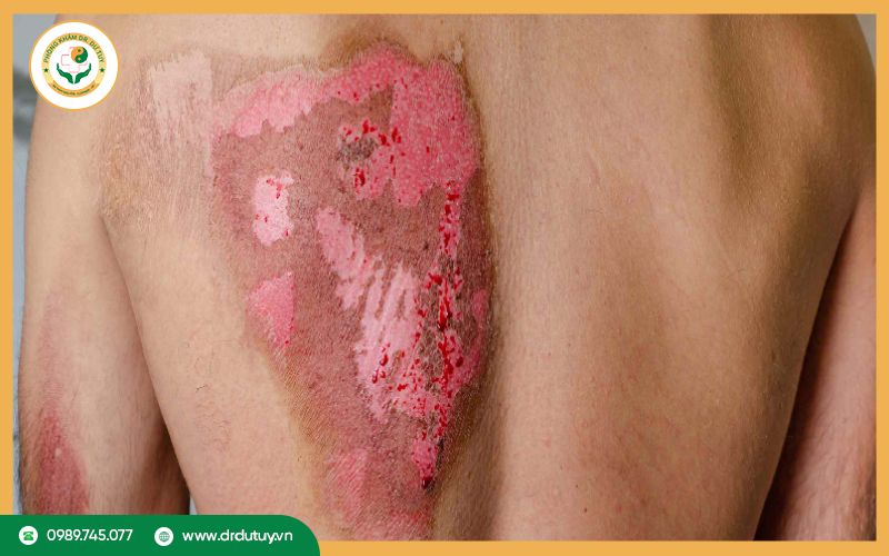 Dấu hiệu vết bỏng nhiễm trùng 