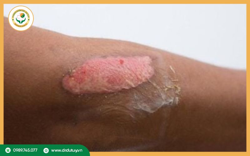 Dấu hiệu vết bỏng nhiễm trùng 