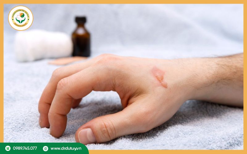 Dấu hiệu vết bỏng nhiễm trùng 