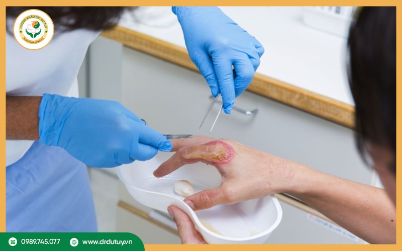 Điều trị vết bỏng nhiễm trùng
