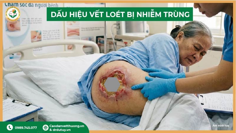 dấu hiệu vết loét bj nhiễm trùng