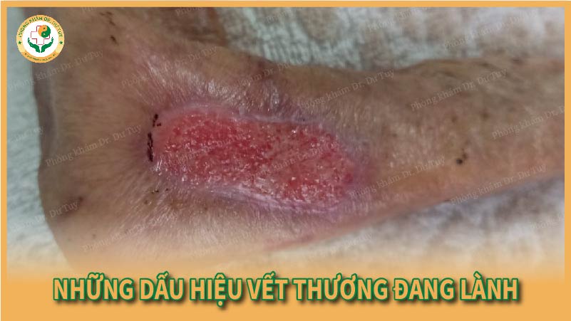 Những dấu hiệu vết thương đang lành