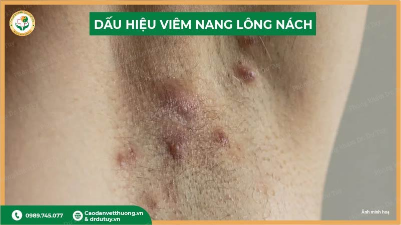 dấu hiệu viêm nang lông nách