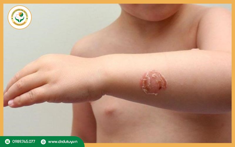 Cao đông y hỗ trợ điều trị lở loét ngoài da