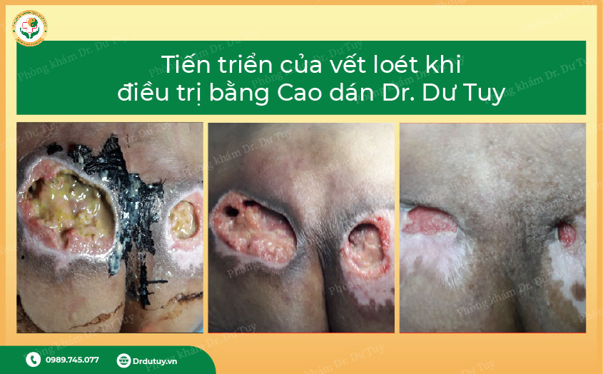 dịch mủ vết loét