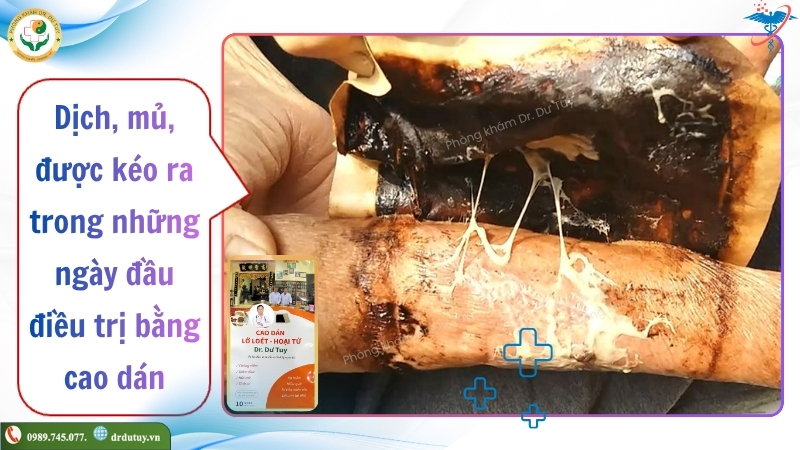 dịch vết thương trên miếng cao dán