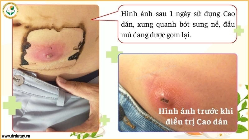 diễn biến ổ áp xe sau 1 ngày dán cao