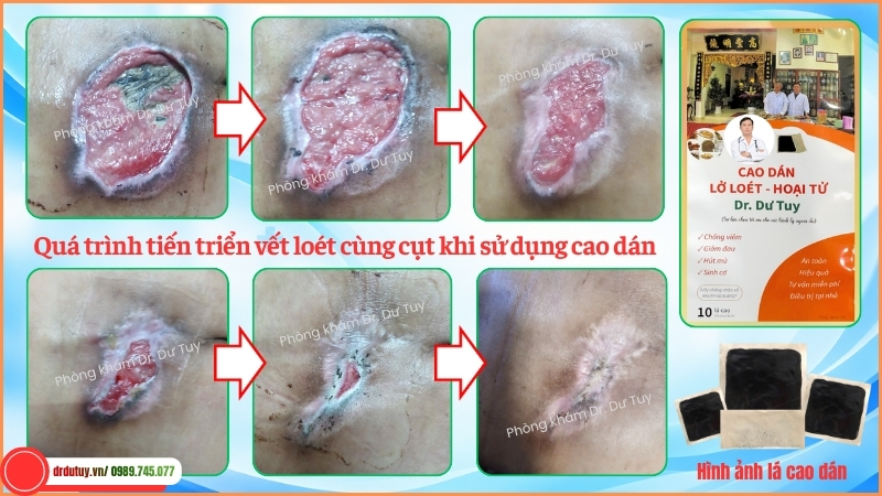 diễn biến thu hẹp vết loét cùng cụt