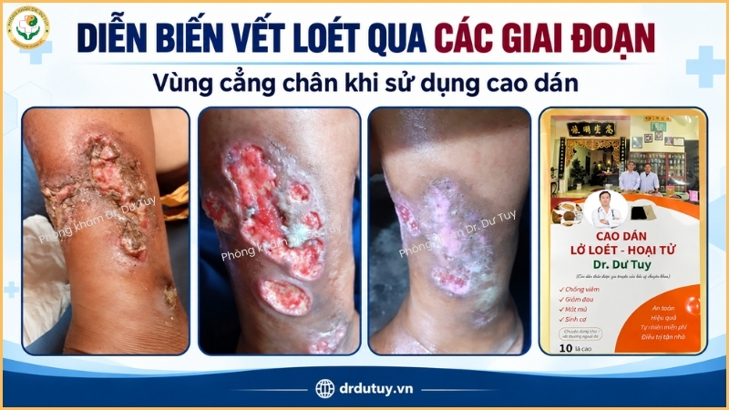 diễn biến vết loét cẳng chân