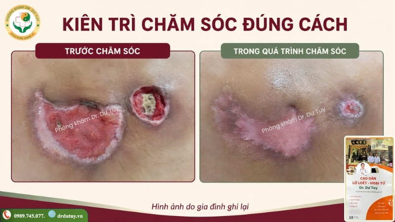 diễn biến vết loét trong quá trình chăm sóc