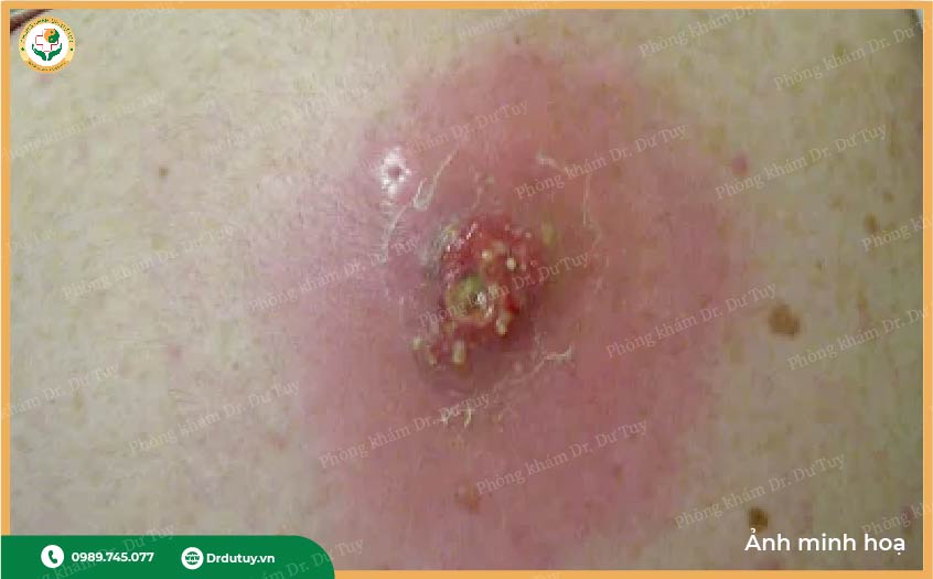 điều trị áp xe da