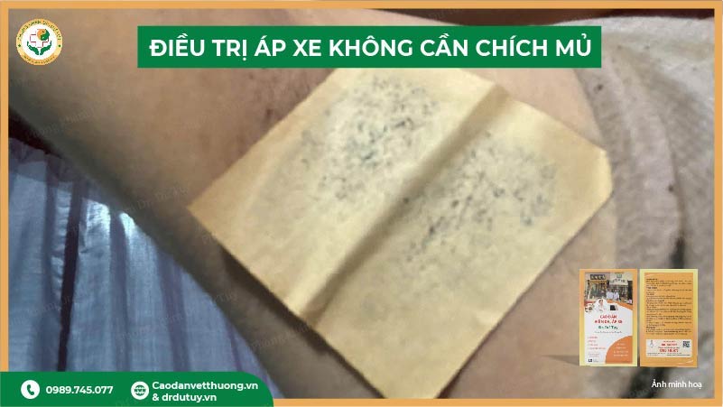 điều trị áp xe không cần chích mủ