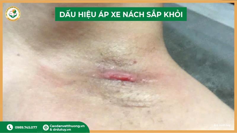 điều trị áp xe nách