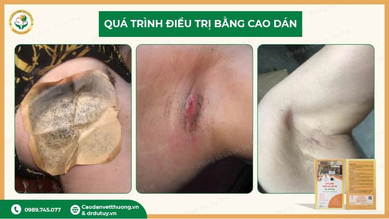 điều trị áp xe nách bằng cao dán