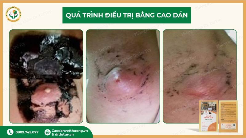 điều trị áp xe nách cao dán