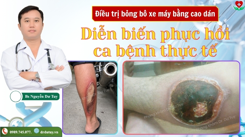 Điều trị bỏng bô xe máy bằng cao dán: Diễn biến phục hồi qua ca bệnh thực tế