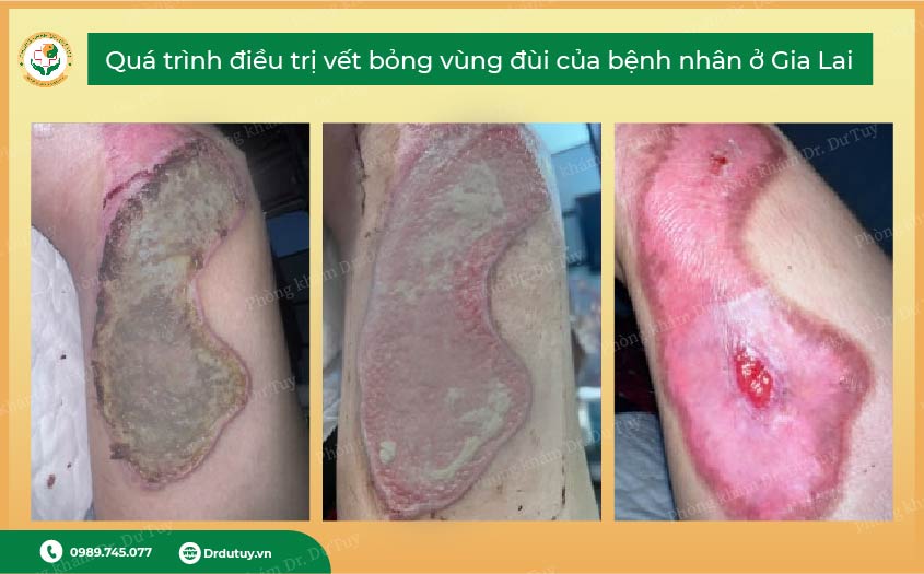 điều trị bỏng không để lại sẹo