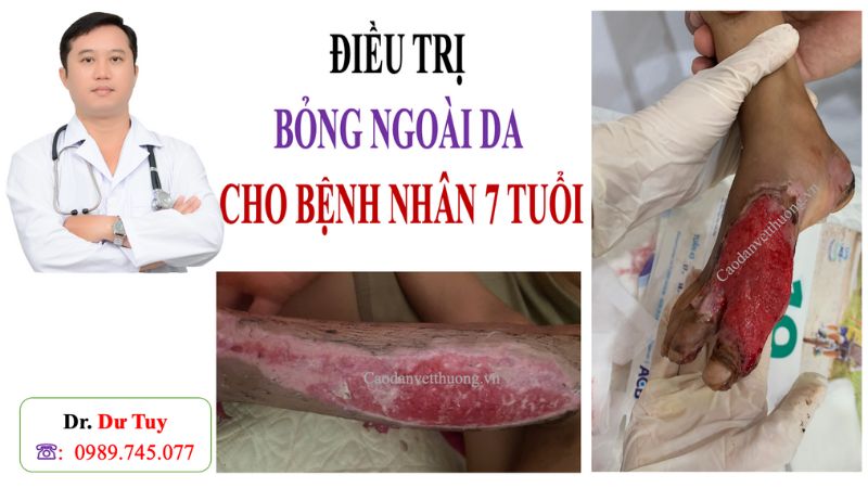 Cách chữa vết bỏng bị phồng rộp