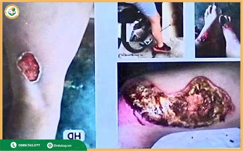 điều trị bỏng tại nhà