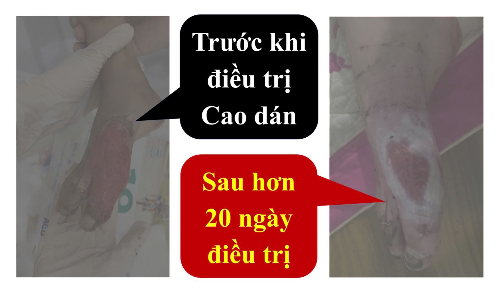 Điều trị bỏng