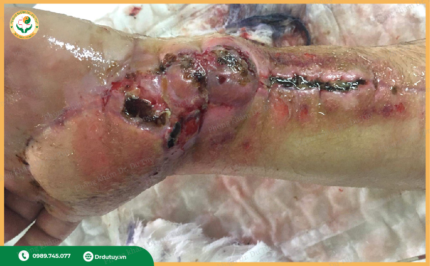 Hoại tử là gì?