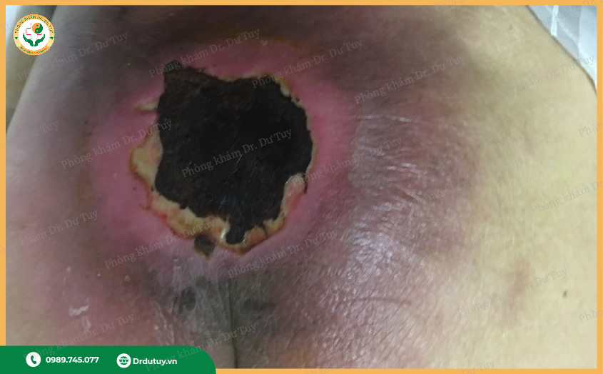 Các loại hoại tử thường gặp phải