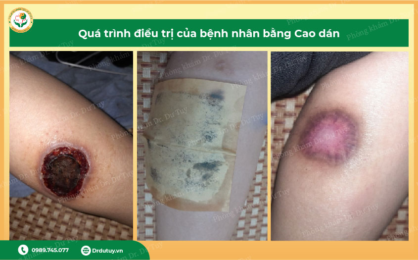 điều trị hoại tử da