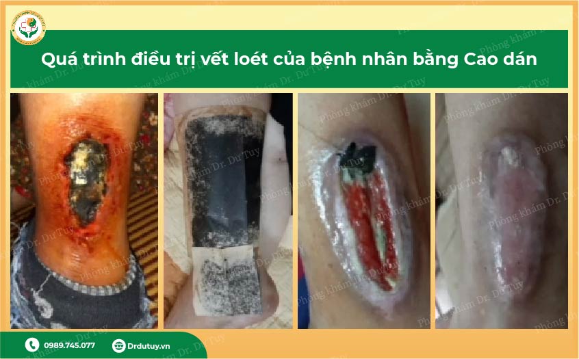 điều trị hoại tử không cần kháng sinh