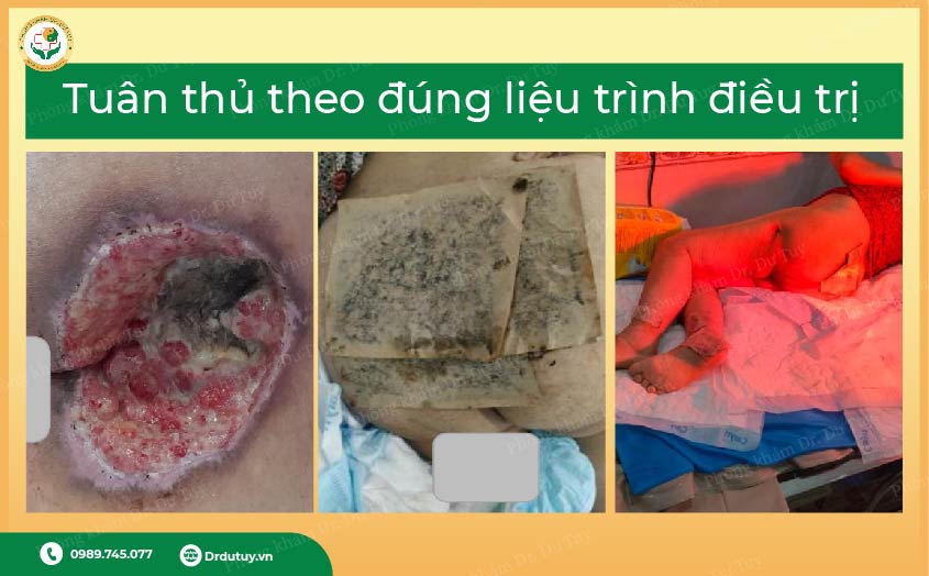 điều trị lở loét bằng cao dán