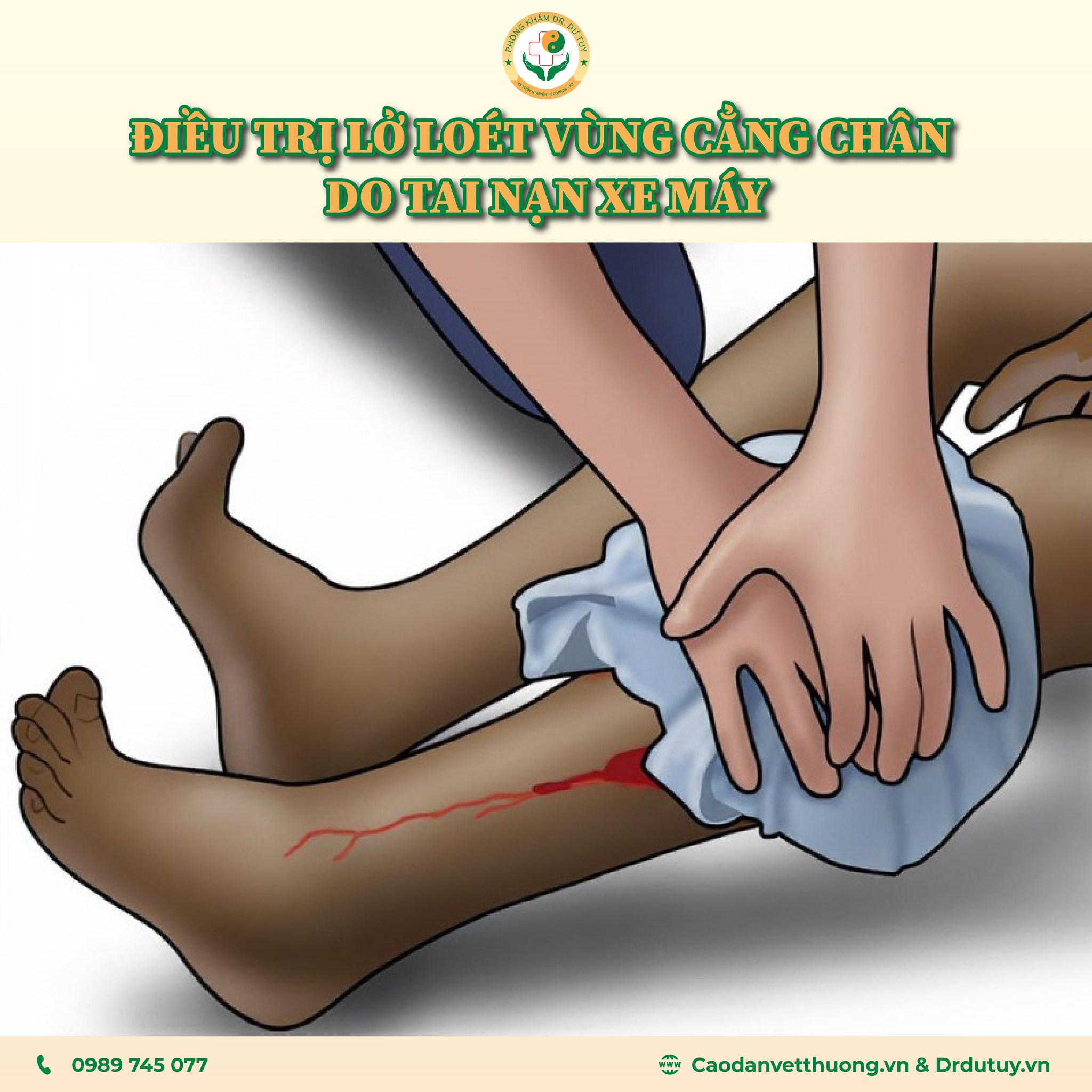 Điều trị loét da vùng cẳng chân cho bệnh nhân bị tai nạn xe máy
