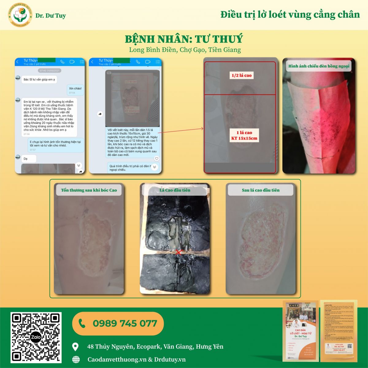 Tiến triển trong quá trình điều trị bằng Cao dán