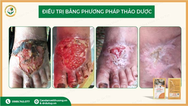 điều trị loét da bằng thảo dược
