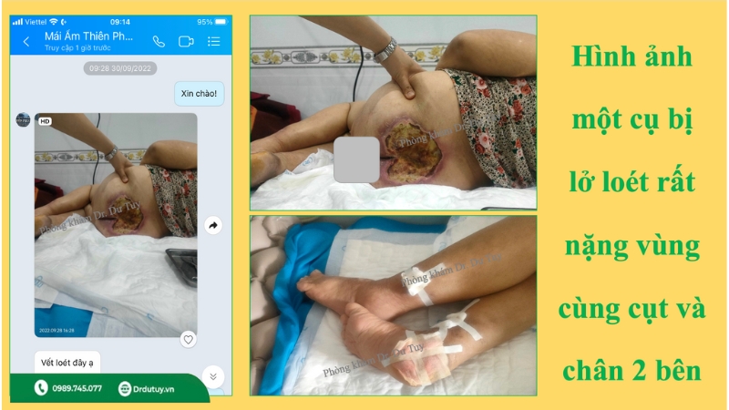 điều trị lở loét da người già