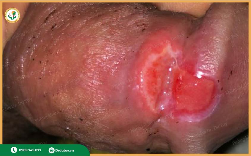 điều trị loét dương vật tại nhà