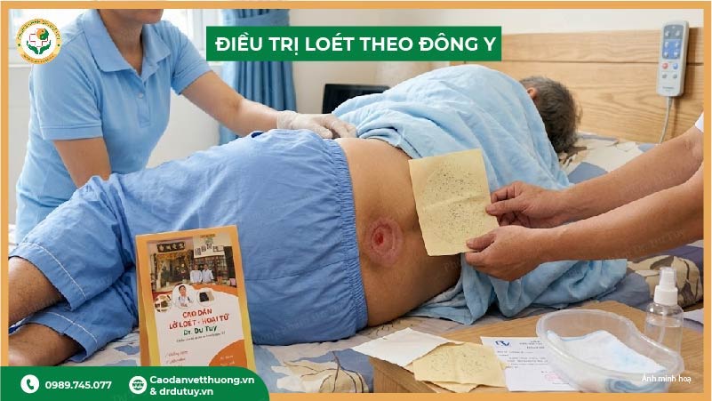 điều trị loét tỳ đè theo đông y
