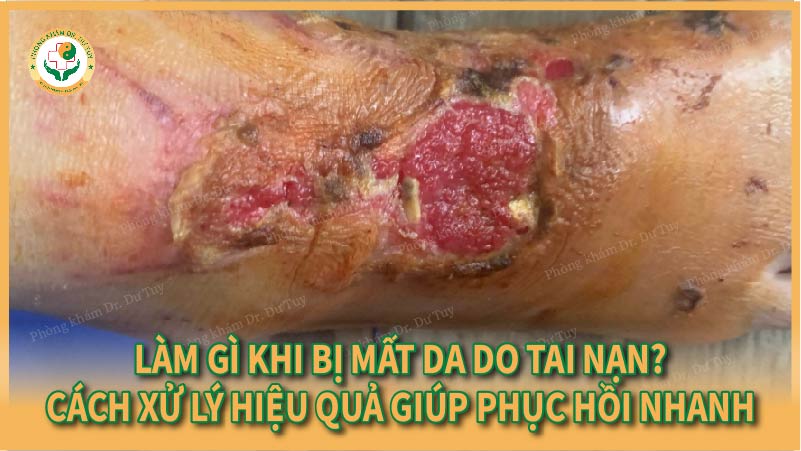 Làm gì khi bị mất da do tai nạn? Cách xử lý hiệu quả giúp phục hồi nhanh