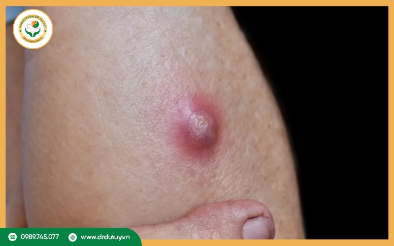 Biến chứng khi không điều trị mụn nhọt
