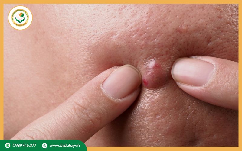Biện pháp phòng ngừa mụn nhọt