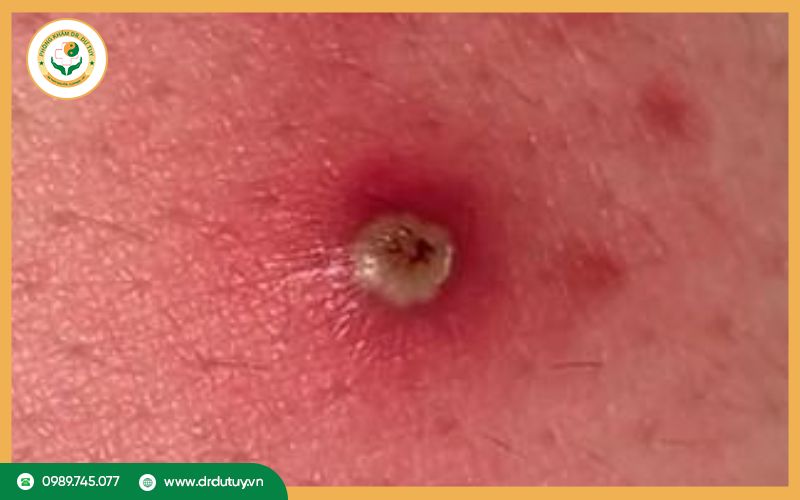 Nguyên nhân gây ra mụn nhọt