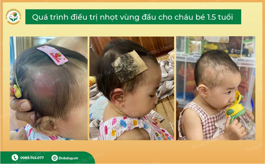 điều trị mụn nhọt cho trẻ