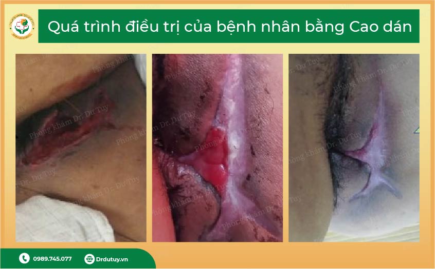 điều trị sau mổ rò hậu môn