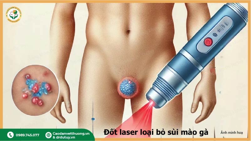 điều trị sùi mào gà bằng laser