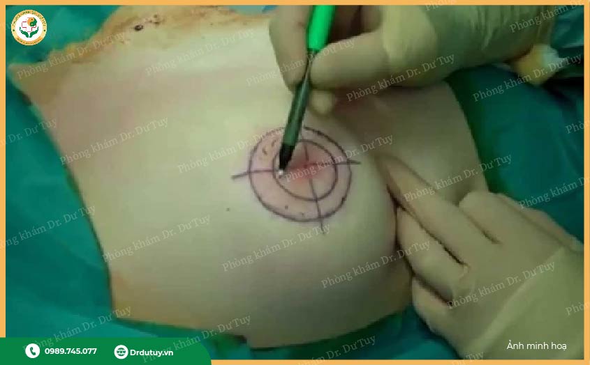 điều trị tai biến sau phẫu thuật thẩm mỹ