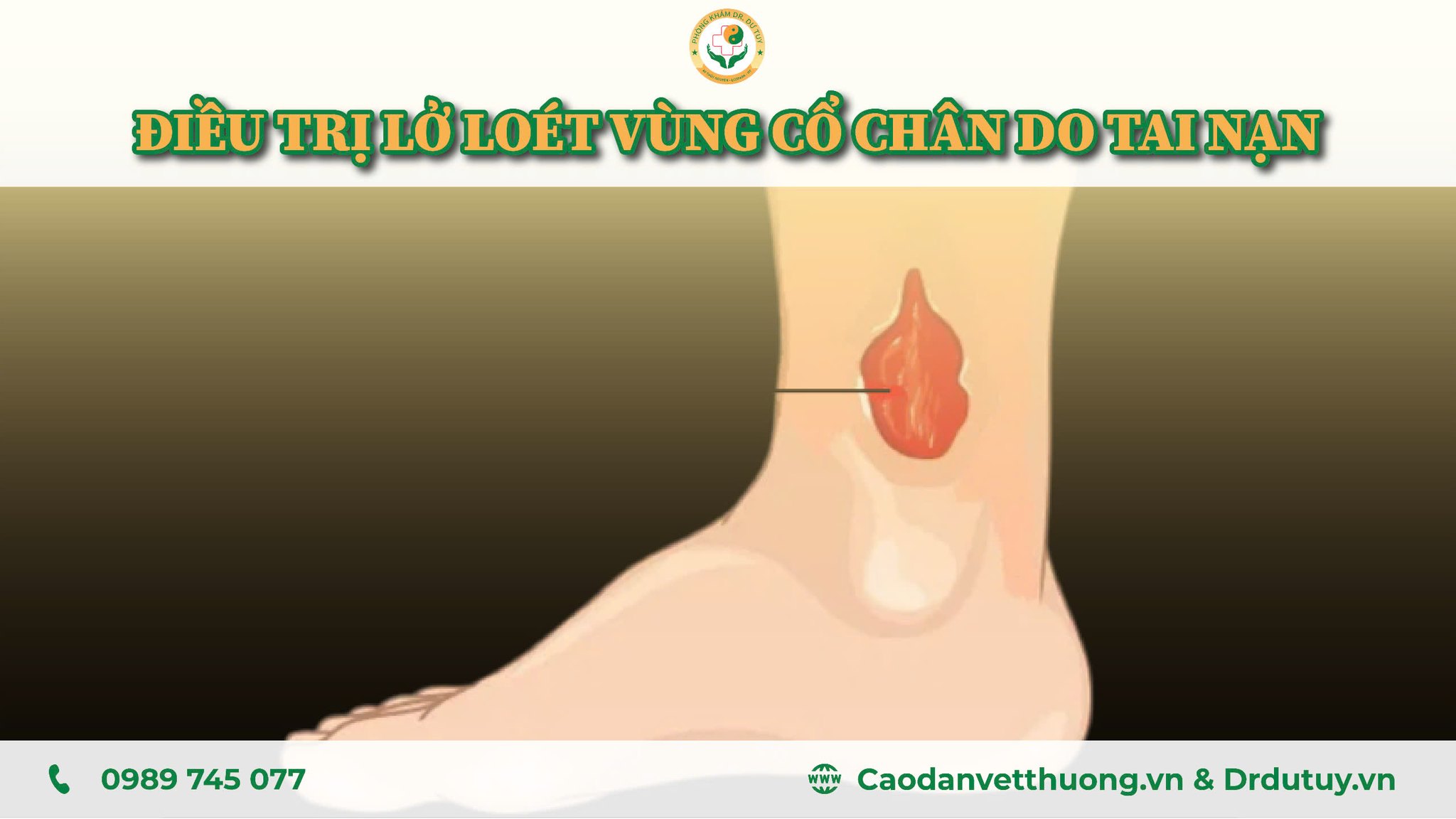 Điều trị lở loét vùng cổ chân cho bệnh nhân sau tai nạn giao thông