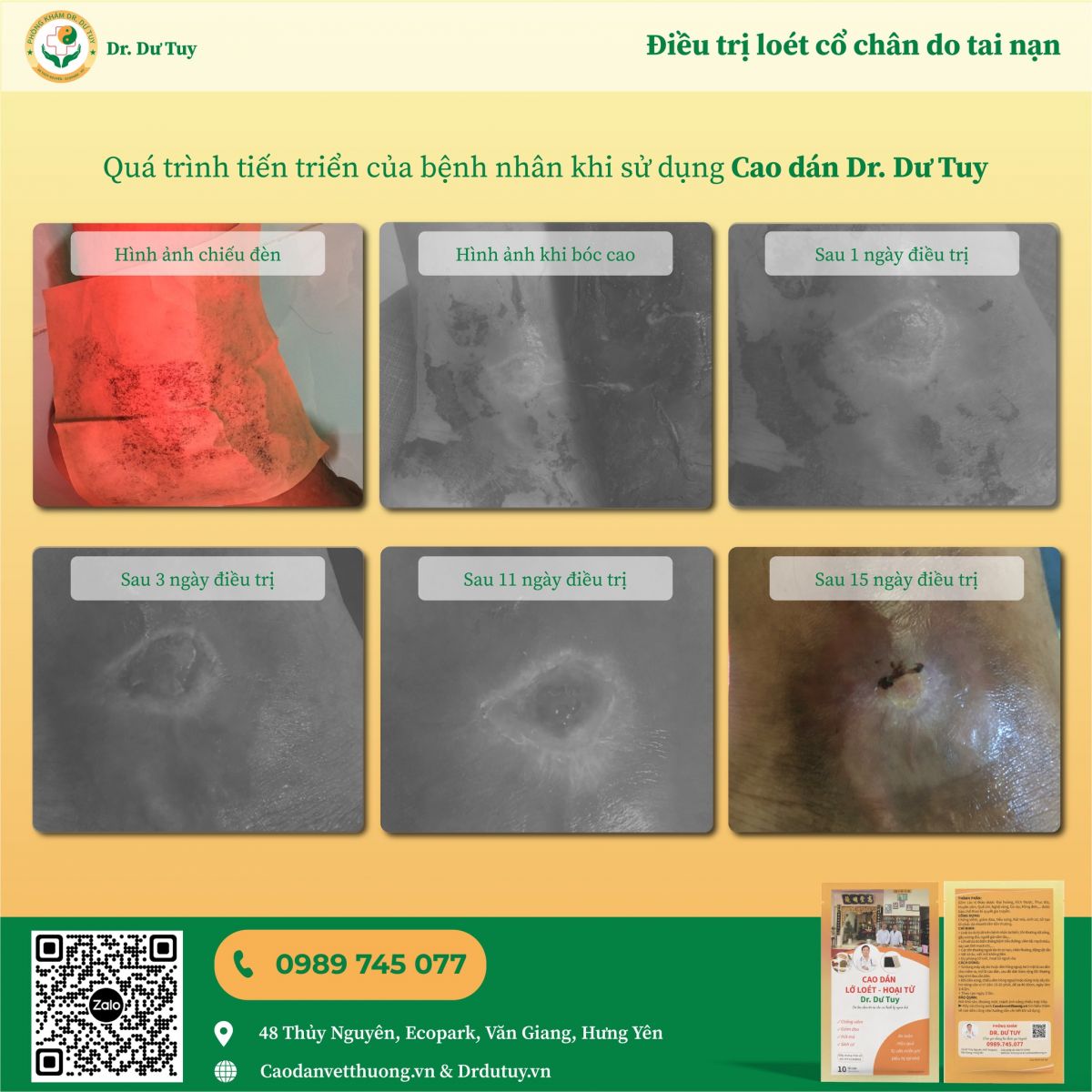 điều trị loét cổ chân