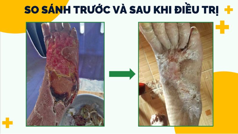 điều trị vết loét